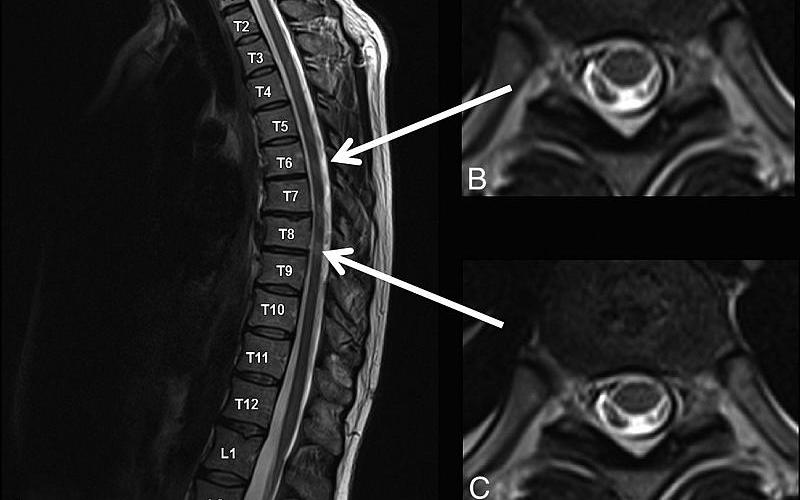 Rezonanta magnetica a segmentului vertebro-medular