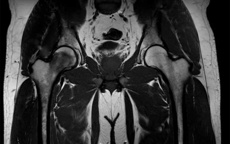Rezonanta magnetica abdomeno pelvina